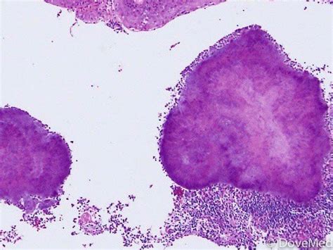 Actinomycosis