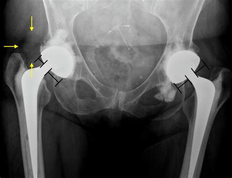 Complication Of Intraprosthetic Dislocation Of Dual Mobility Hip