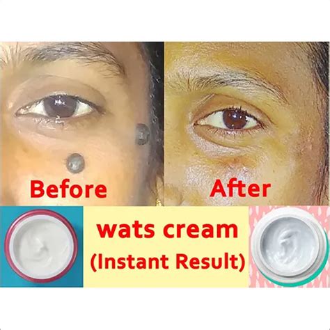 Warts Mole Removal Cream At Best Price In Pudukkottai T Needs Ap