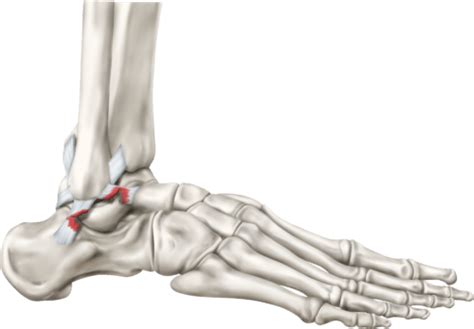 Rupture Des Ligaments De La Cheville Dr Nicolas Pinar