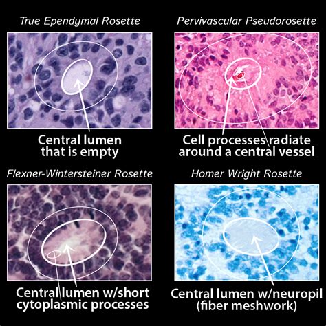 Pathology Glossary Rosettes And Pseudorosettes Draw It To Know It