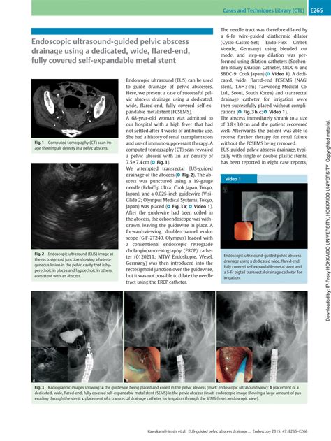 (PDF) Endoscopic ultrasound-guided pelvic abscess drainage using a ...