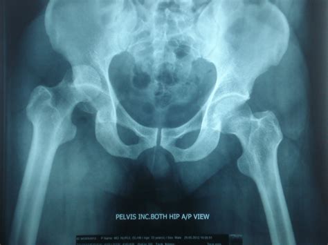 X-rays and Slides: Posterior dislocation of Right hip