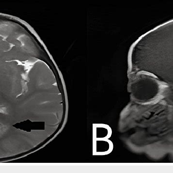 MRI Of The Brain Shows Symmetrical Moderate Enhancing Altered Signal