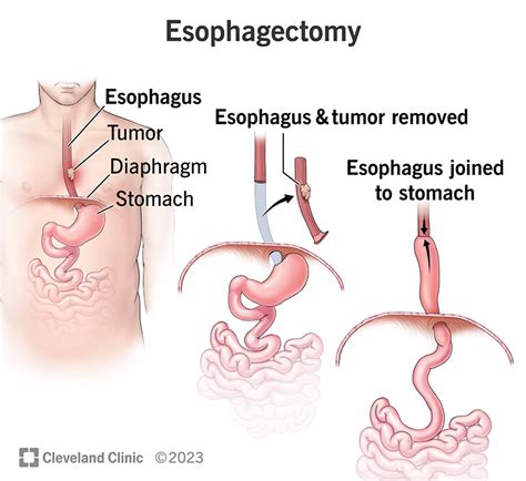 Esophagectomy: Types, Surgery, Recovery & Complications