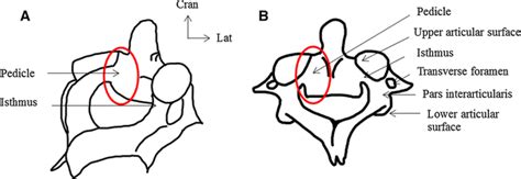 Anatomical Localization Of The Pars Interarticularis And The Pedicle