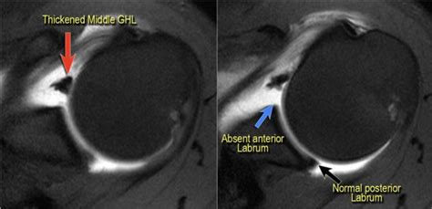 Shoulder Anatomy And Variants On Mri 2022