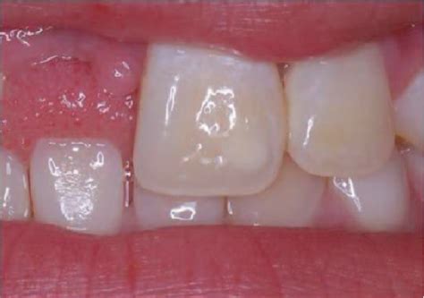 Figure From Limitations Of Enamel Microabrasion Technique Applied In