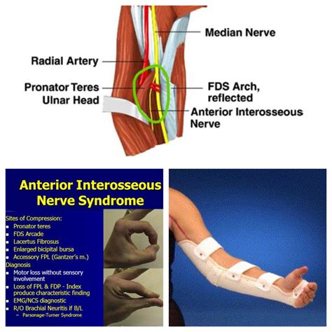 Anterior Interosseous Nerve Compression