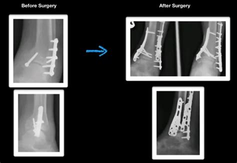 Pilon Fractures Robert Sheinberg Dpm Weston Fl Podiatrist