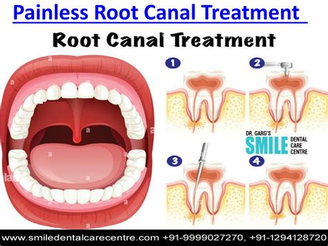 Ppt Painless Root Canal Treatment Everything You Need To Know Before