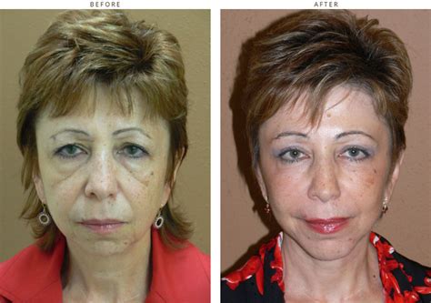 Mid Face Lift – Before and After Pictures * | Dr Turowski - Plastic ...