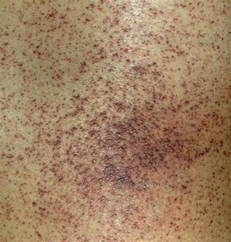 Angiokeratoma Causes Pictures Symptoms Treatment