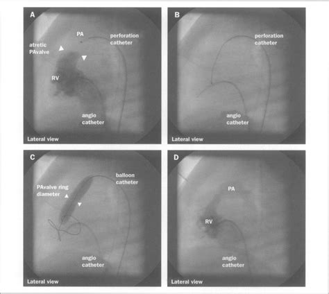 Cardiac Catheterisation Procedure 2A Rtight Ventriculography Before