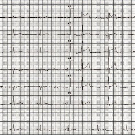 The patient’s electrocardiogram showed sinus rhythm, normal P-wave... | Download Scientific Diagram