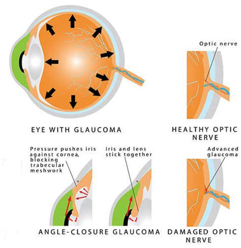 Glaucoma Jacksonville Eye Exam Jacksonville Nc Office Park Eye