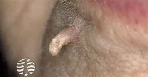 Dermnet Cutaneous Horn Image