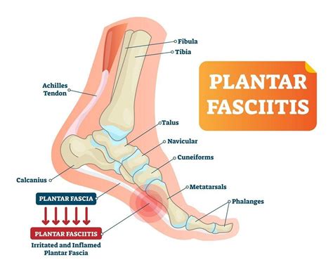 How To Treat A Plantar Fasciitis Golf Ball Plantar People