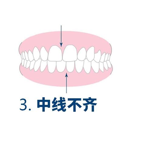 牙齿错颌畸形有多少种类型？你想了解都在这里 知乎