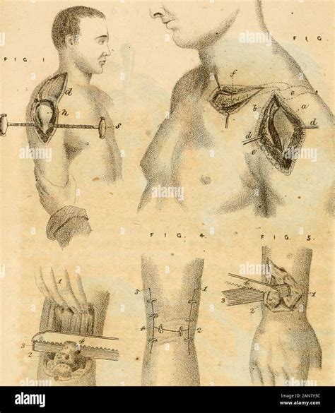 shoulder clavicle resection  res stock photography  images alamy