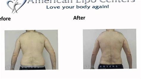 Laser Liposuction Virginia Beach Before And After Photos Youtube