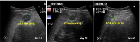 Ultrasound Follow Up A The Accessory Spleen Shrunk To 24 6 Mm 94 Download Scientific