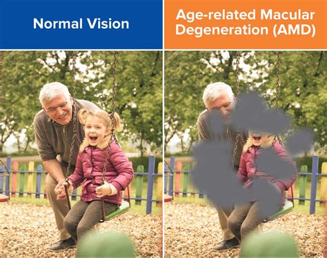 Syfovre: Dry Macular Degeneration Treatment in Venice FL