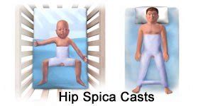 Hip Spica Cast Care in Children (Aftercare Instructions)