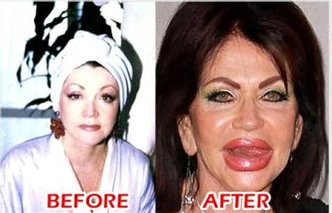 22 Most Shocking Celebrity Before And After Plastic Surgery Shots ...