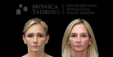 Blepharoplasty 04 Dr Monica Tadros Sinus Sleep Facial Plastic