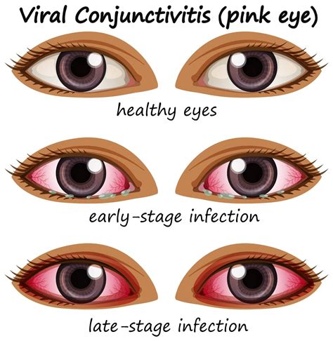 Pink Eye- Symptoms, Causes and Treatment