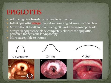 Paediatric Airway