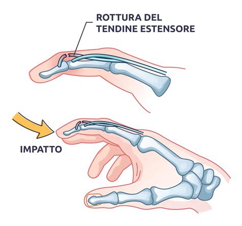 Riverbero Partecipante Bourgeon Ricostruzione Tendine Dito Mano