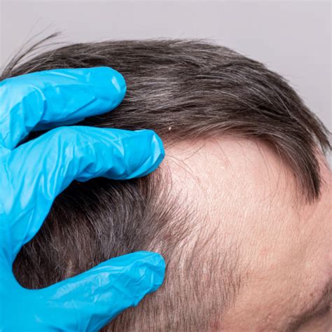 Finasteride Propecia For Hair Loss Florida Hair Transplant Center