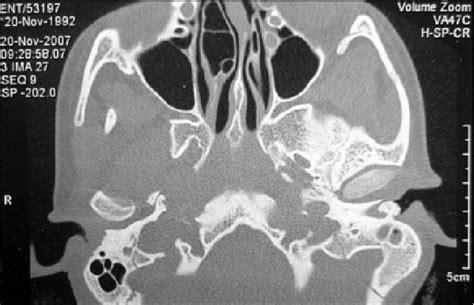 Figure 1 From Osteoma And Exostosis Of External Auditory Canal