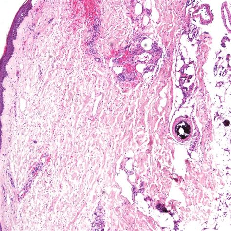 Histopathological Examination Of A Skin Biopsy Taken From The Edge Of