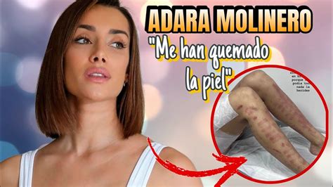 Adara Molinero Ense A Las Quemaduras Que Le Han Hecho En Una Cl Nica