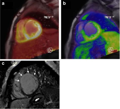 Hybrid Cardiac Imaging Using PET MRI A Joint Position Statement By The