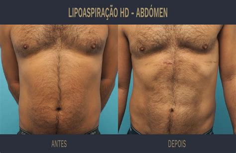 Casos Cl Nicos Lipo Hd Rc