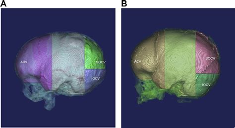 Analysis Of The Cephalometric Changes In The First Months After