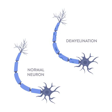 Demyelination: Symptoms, Causes, Diagnosis, Treatment