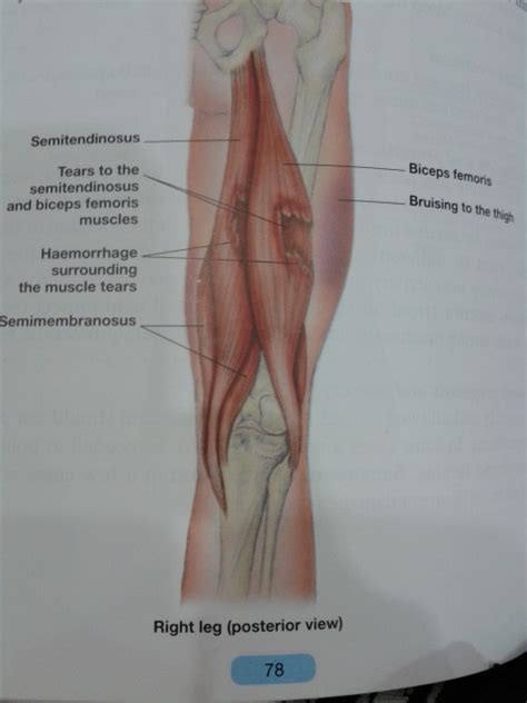 Hamstring Tendinitis | 👨‍⚕️Singapore Orthopaedic & Neurosurgery Clinic