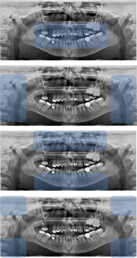 Areas of interest in the panoramic radiograph for radiographic ...