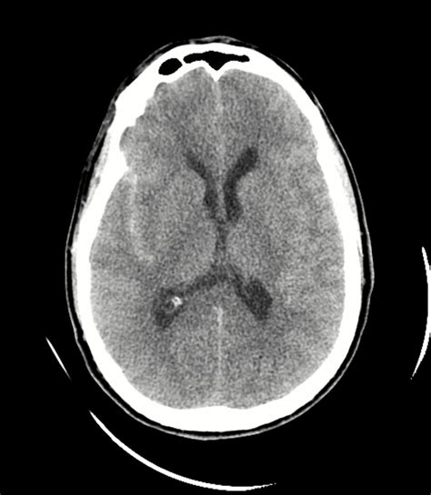 Ruptured M2 Pseudoaneurysm Pipeline Shield Embolization