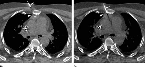 Artificial Widening Of The Mediastinum For The Parasternal Approach Download Scientific