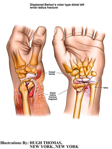 Barton Fracture Anatomy And Physiology Medical Medical Imaging