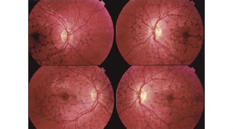 Photokeratitis Causes Symptoms And Management Obn