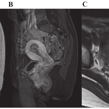 Pelvic Magnetic Resonance Imaging A T Weighted Sagittal B