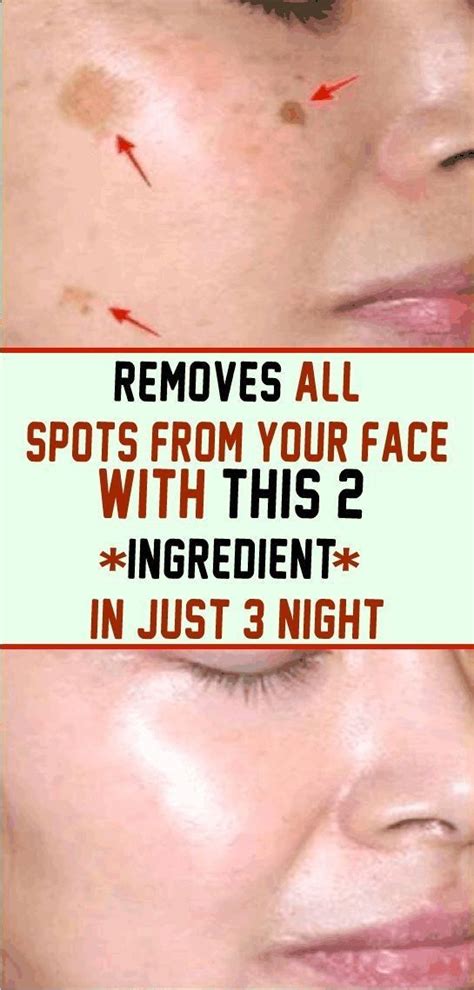 Removes All Spots On Your Face In Just 3 Nights In 2020 Remove Dark