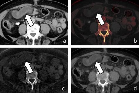 Portal Venous Phase Split Filter Dual Energy CT Of The Abdomen In An